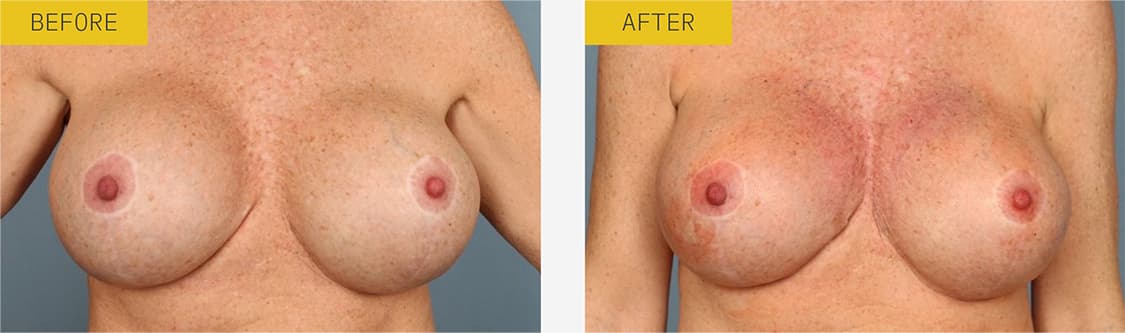 Day 0, 18 CC alloClae to right medial breast, 7 CC to left breast