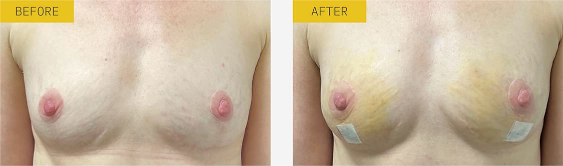 1 week post procedure, 50 CC alloClae to each breast