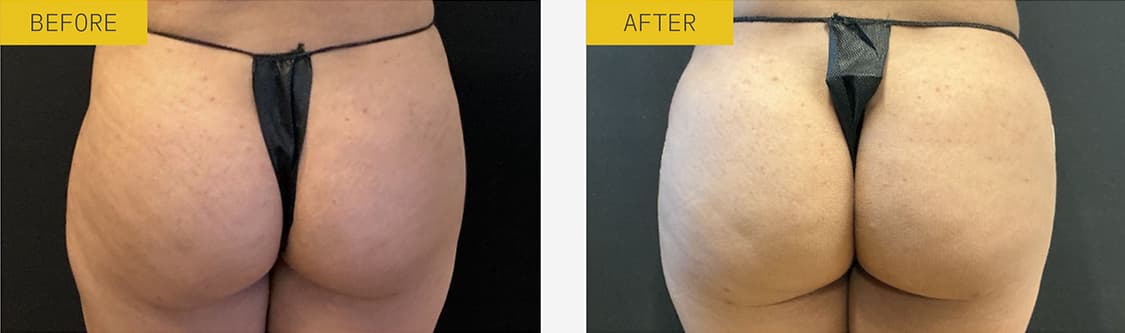 1 month post procedure, 12.5 CC alloClae to left hip dip