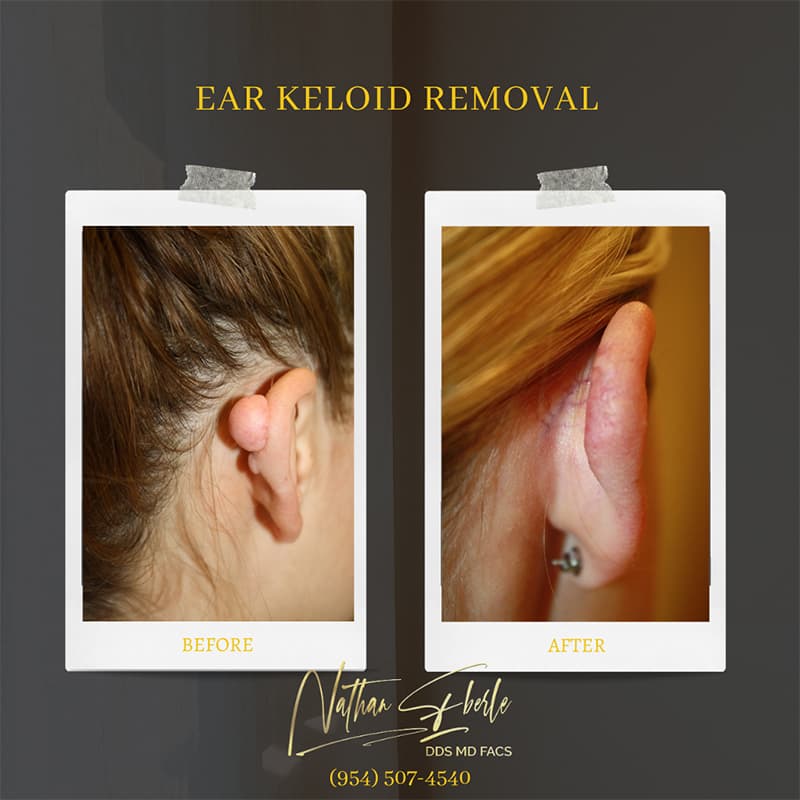 Ear keloid removal before and after - Case 001