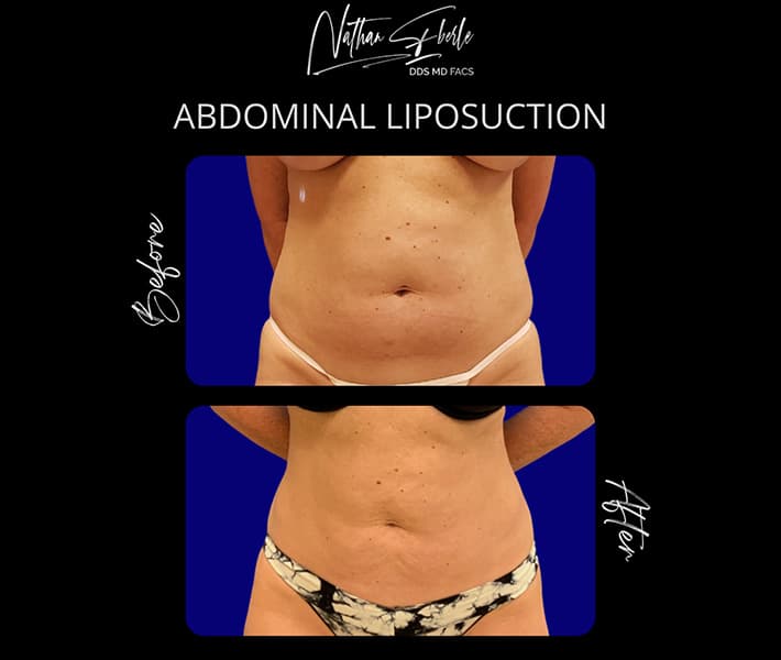Abdominal Liposuction before and after - Actual Patient
