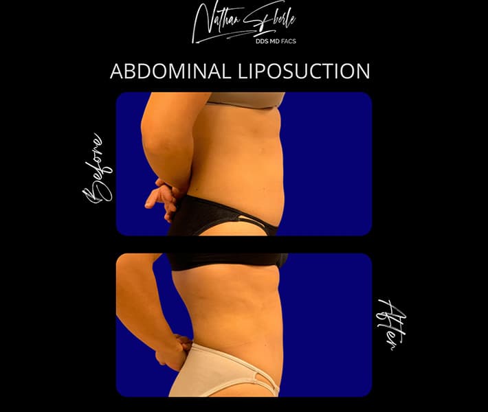 Abdominal Liposuction before and after - Actual Patient