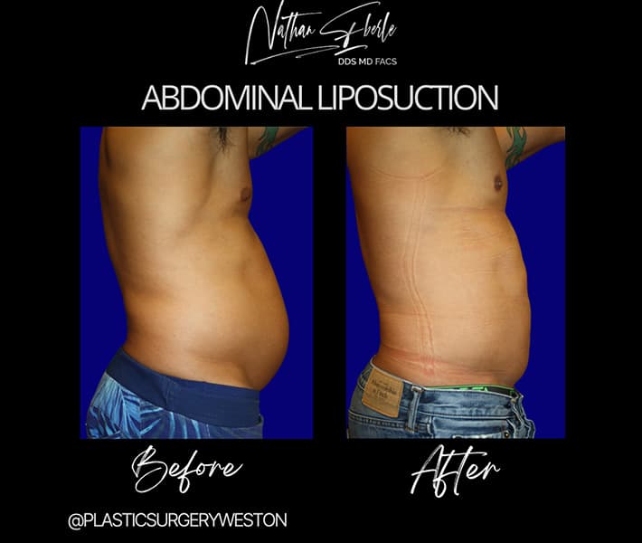 Abdominal Liposuction before and after - Actual Patient