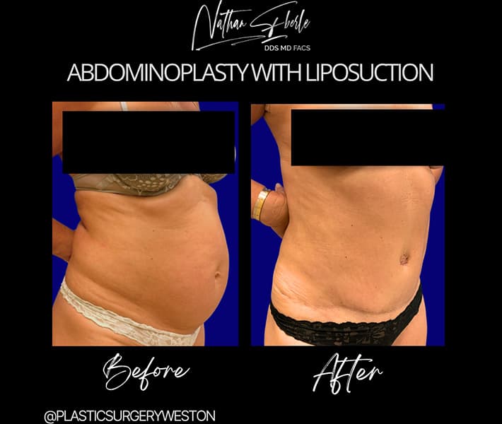 Abdominal Liposuction before and after - Actual Patient