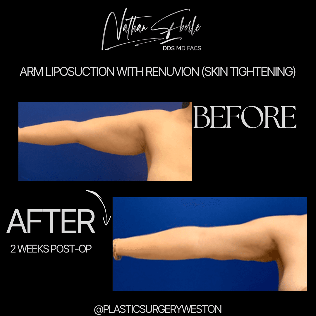 Arm Lift before and after - Actual Patient