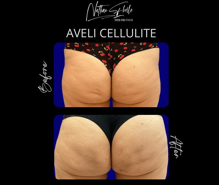 Aveli Cellulite Repair before and after - Actual Patient
