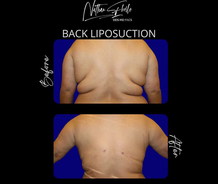 Back Liposuction before and after - Actual Patient