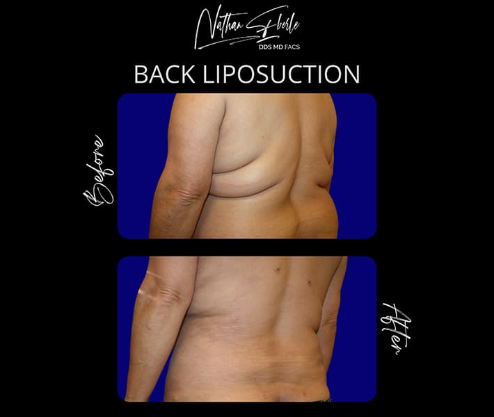 Back Liposuction before and after - Actual Patient