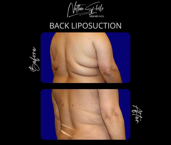Back Liposuction before and after - Actual Patient