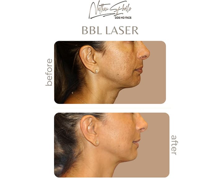 BBL Laser before and after - Actual Patient