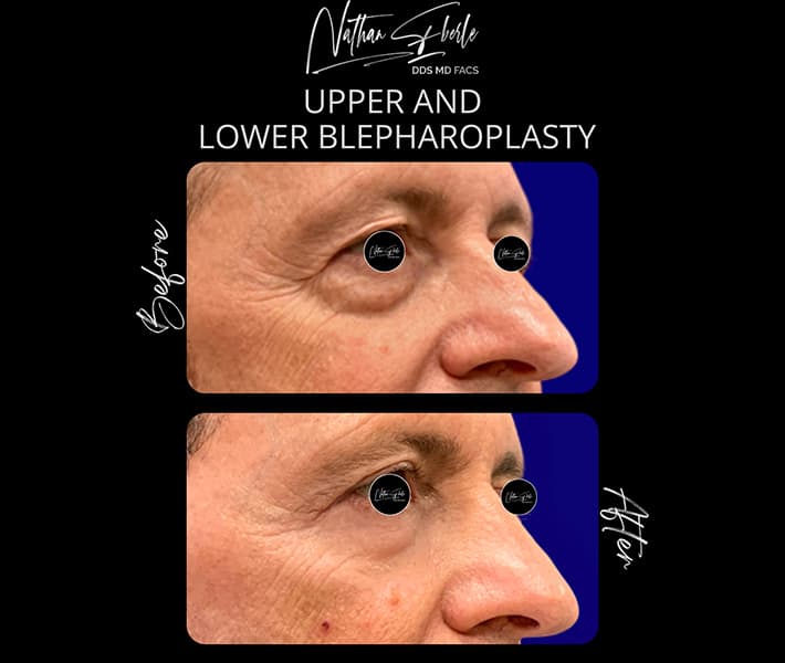 Blepharoplasty before and after - Actual Patient