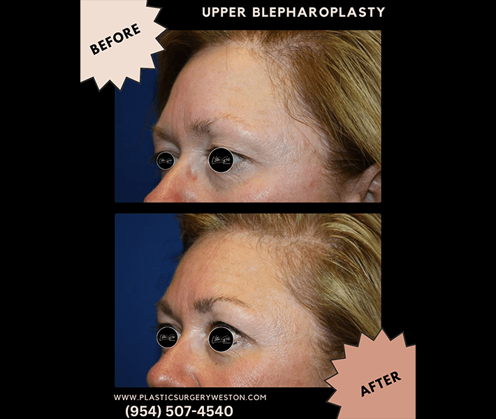 Blepharoplasty before and after - Actual Patient