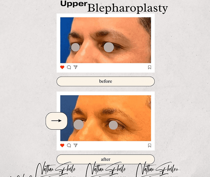 Blepharoplasty before and after - Actual Patient