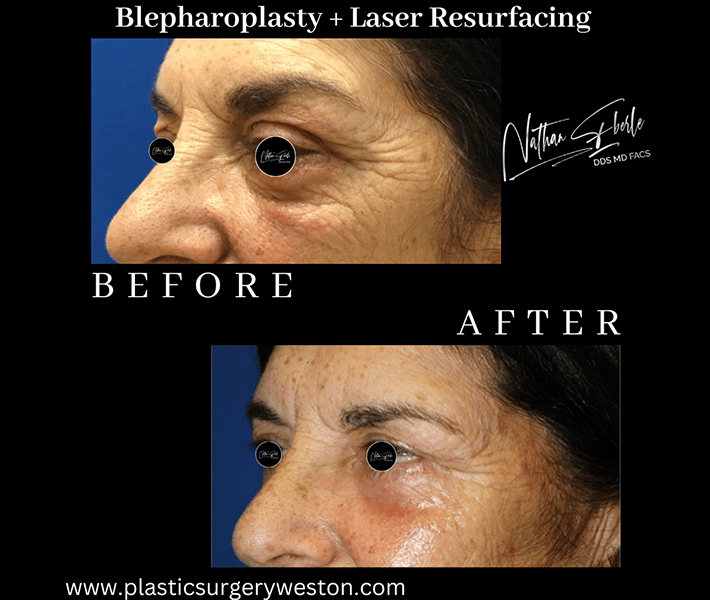 Blepharoplasty before and after - Actual Patient