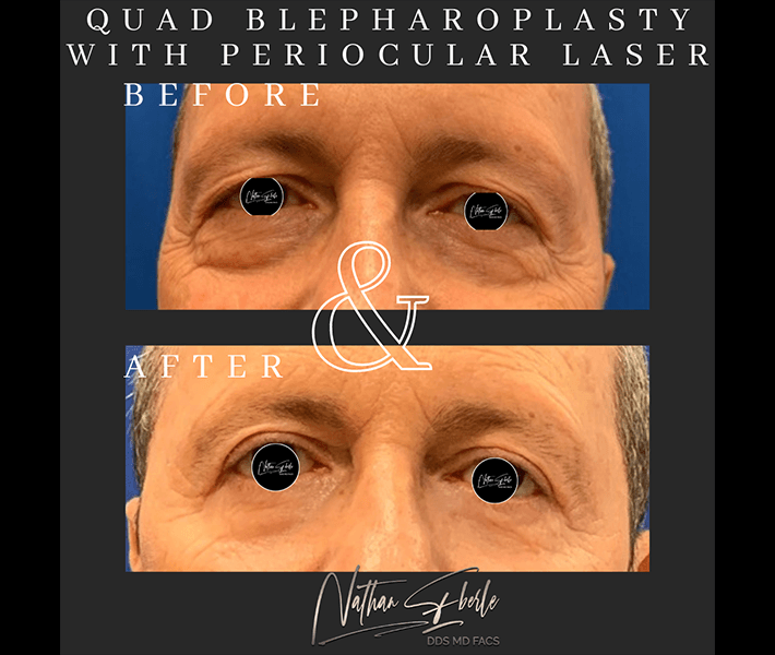Blepharoplasty before and after - Actual Patient