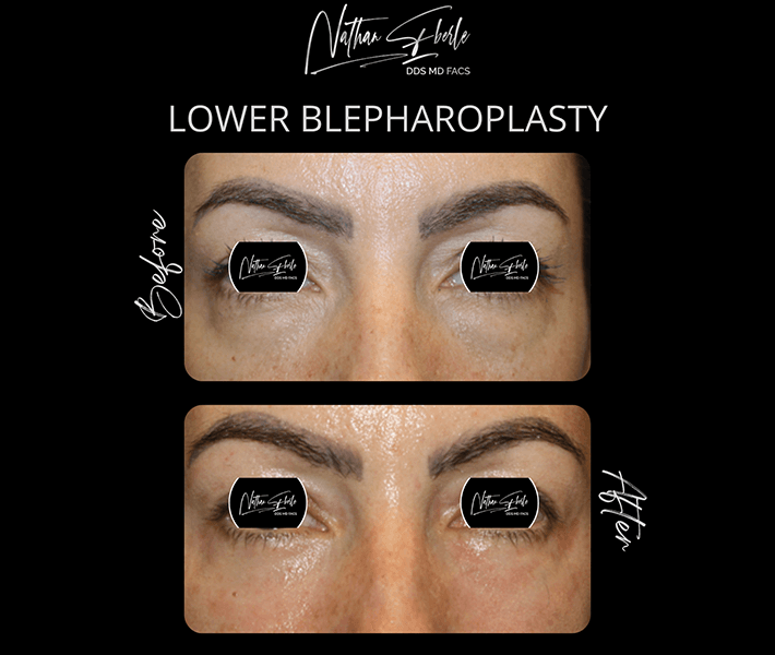 Blepharoplasty before and after - Actual Patient
