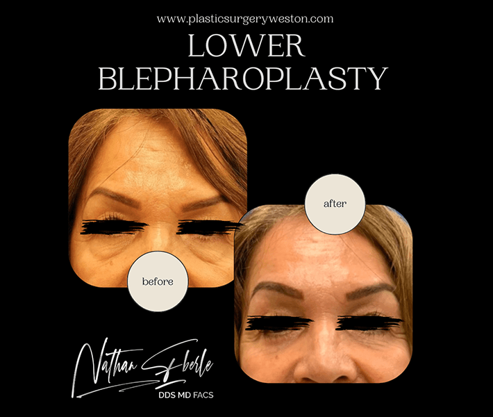 Blepharoplasty before and after - Actual Patient