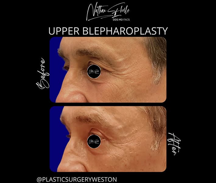 Blepharoplasty before and after - Actual Patient
