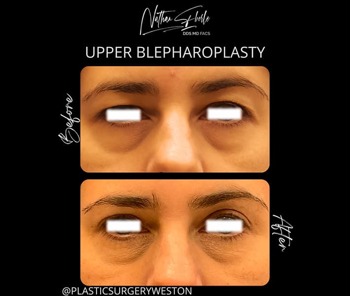 Blepharoplasty before and after - Actual Patient