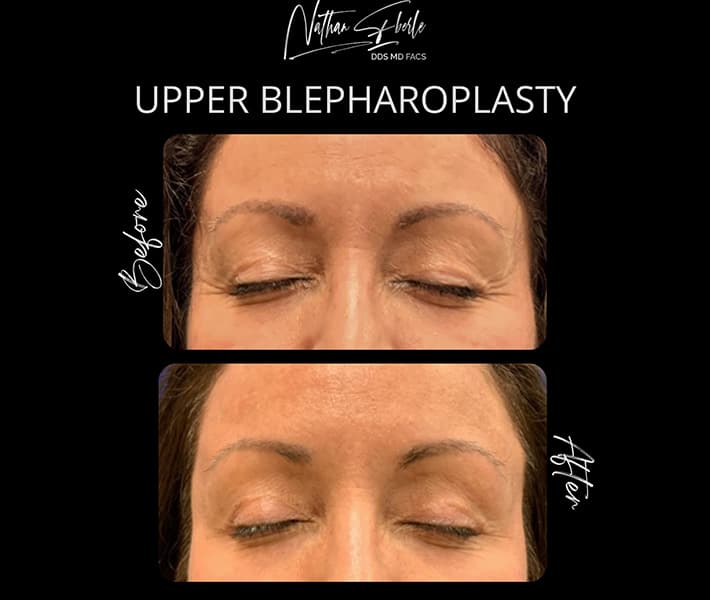 Blepharoplasty before and after - Actual Patient