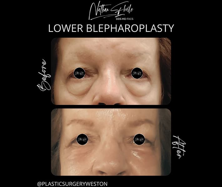 Blepharoplasty before and after - Actual Patient