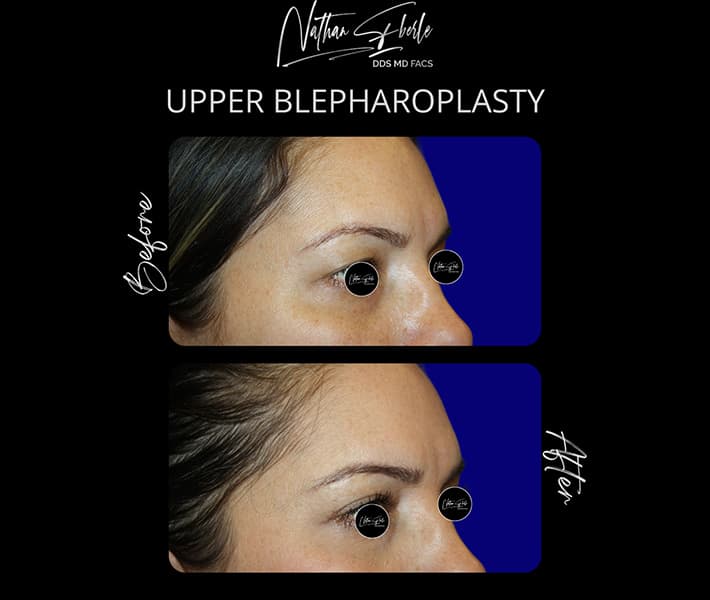Blepharoplasty before and after - Actual Patient