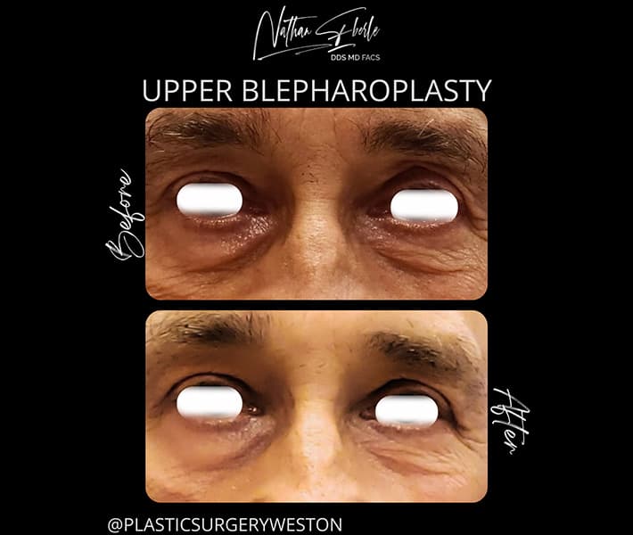 Blepharoplasty before and after - Actual Patient