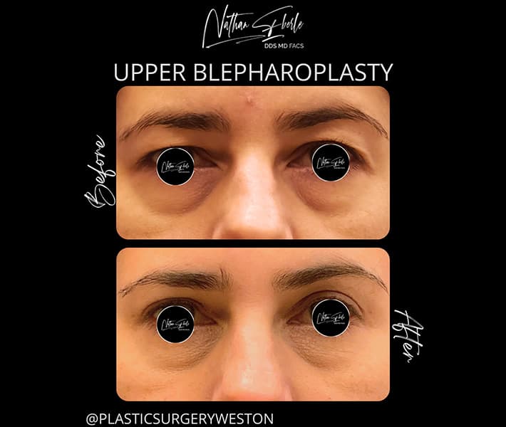 Blepharoplasty before and after - Actual Patient