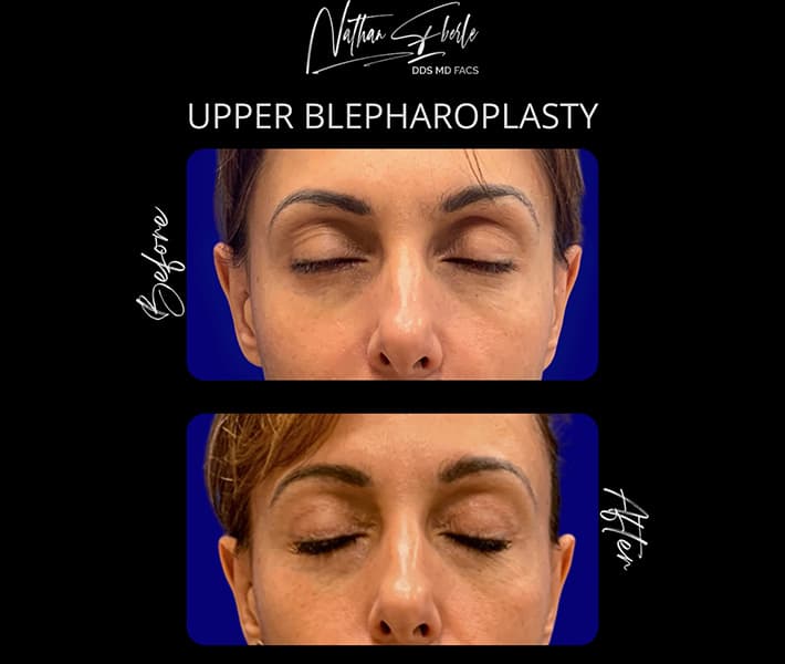 Blepharoplasty before and after - Actual Patient