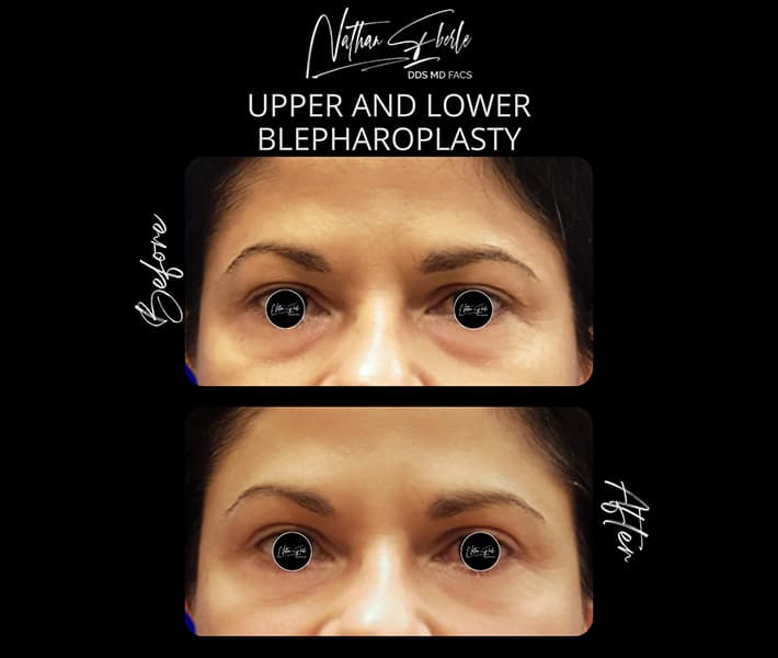 Blepharoplasty before and after - Actual Patient
