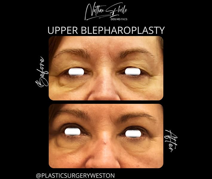 Blepharoplasty before and after - Actual Patient