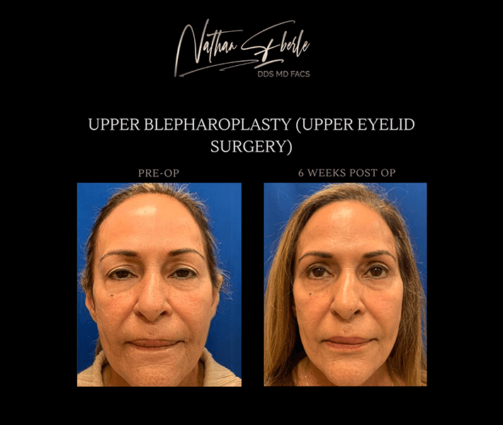Blepharoplasty before and after - Actual Patient