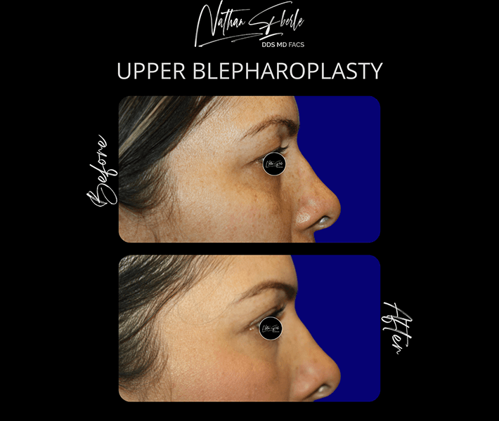 Blepharoplasty before and after - Actual Patient