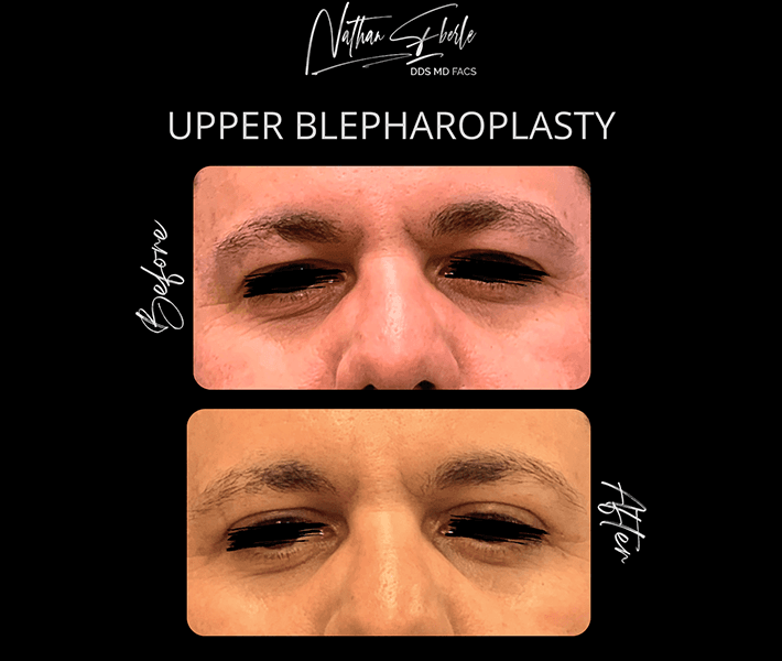 Blepharoplasty before and after - Actual Patient
