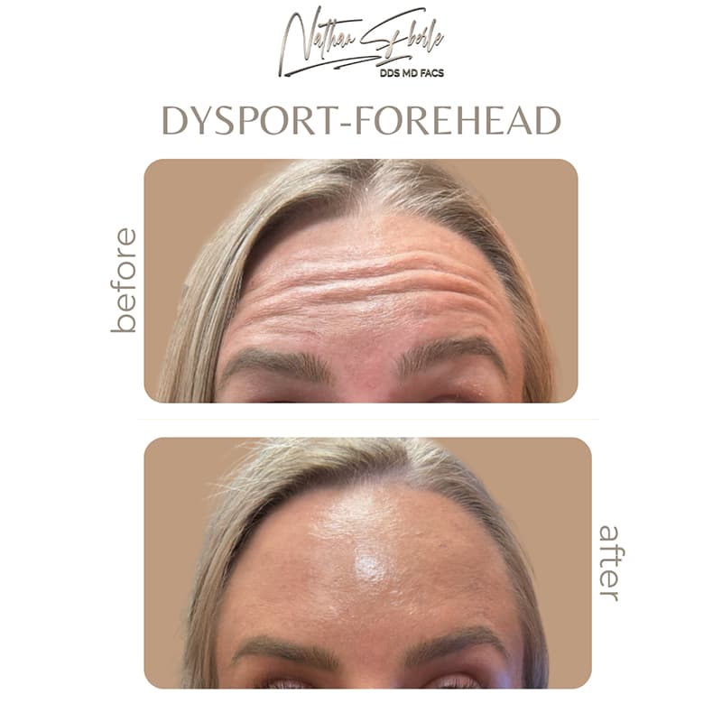 Botox, Jeuveau & Dysport Treatments before and after - Actual Patient