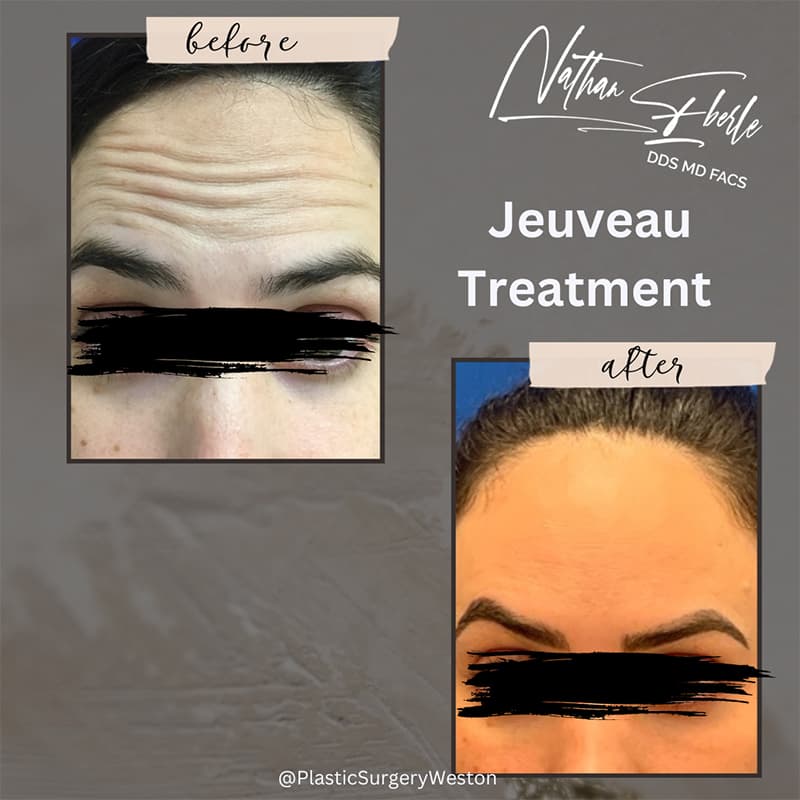 Botox, Jeuveau & Dysport Treatments before and after - Actual Patient