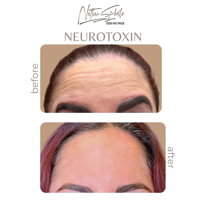 Botox, Jeuveau & Dysport Treatments before and after - Actual Patient