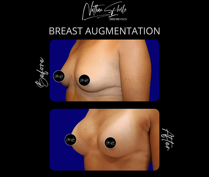 Breast Augmentation before and after - Actual Patient