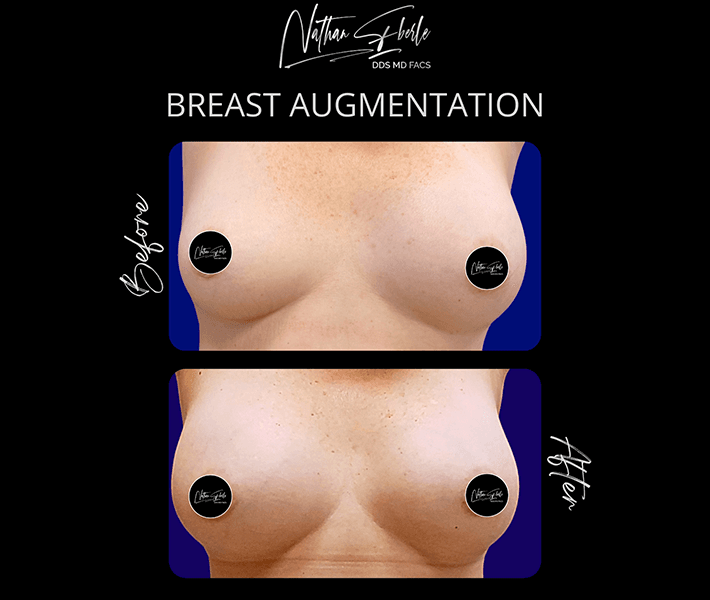 Breast Augmentation before and after - Actual Patient