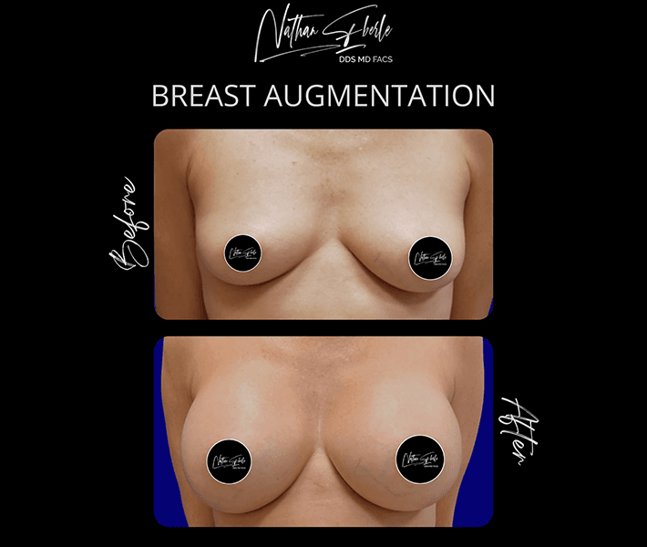 Breast Augmentation before and after - Actual Patient