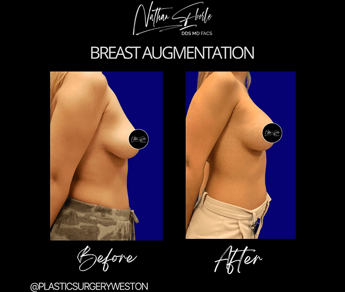 Breast Augmentation before and after - Actual Patient