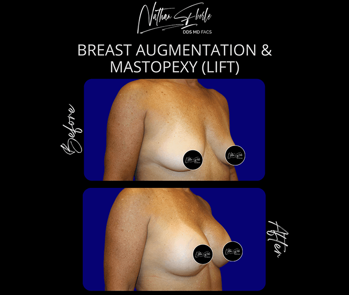 Breast Augmentation before and after - Actual Patient