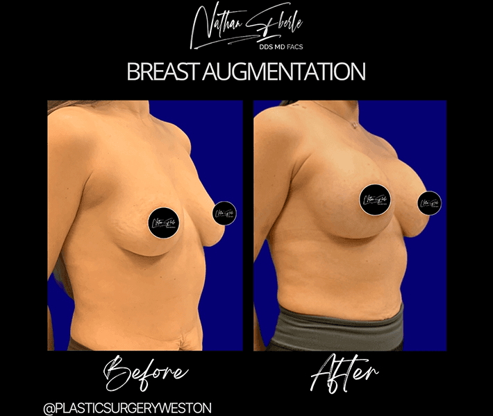 Breast Augmentation before and after - Actual Patient