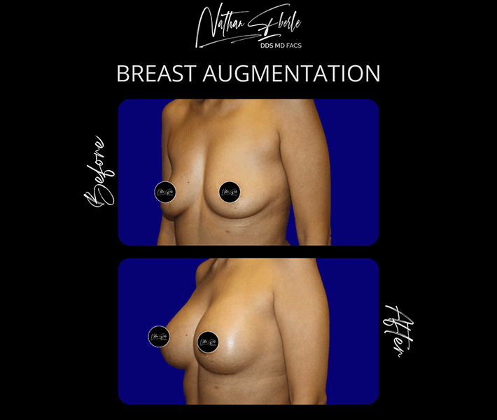 Breast Augmentation before and after - Actual Patient