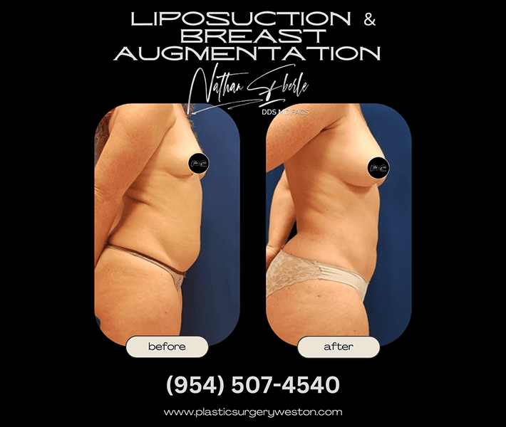 Breast Augmentation before and after - Actual Patient