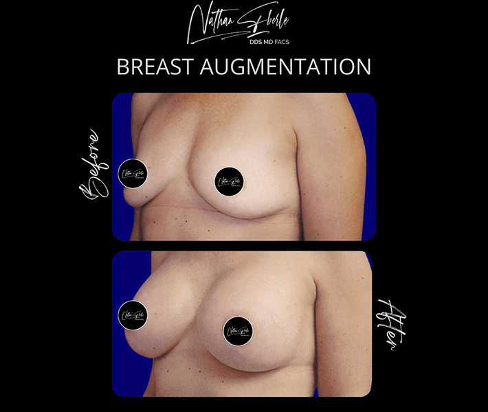 Breast Augmentation before and after - Actual Patient