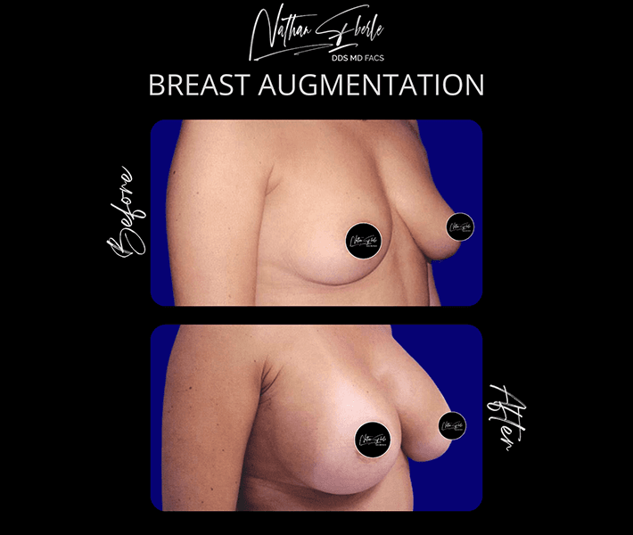 Breast Augmentation before and after - Actual Patient