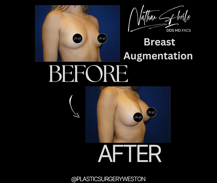 Breast Augmentation before and after - Actual Patient