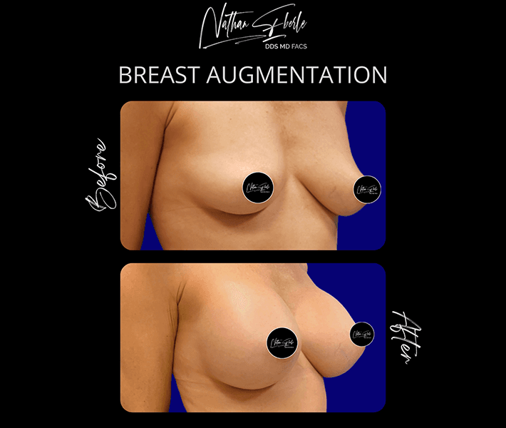 Breast Augmentation before and after - Actual Patient