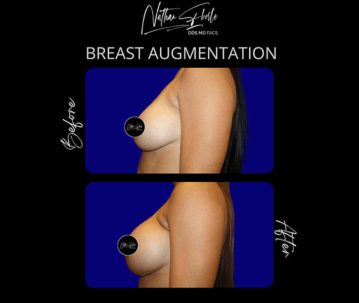 Breast Augmentation before and after - Actual Patient